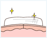 STEP4 圧迫と術後処置のイメージ