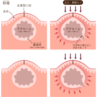 粉瘤（アテローム）の説明イラスト