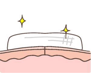 粉瘤治療の流れイラスト4